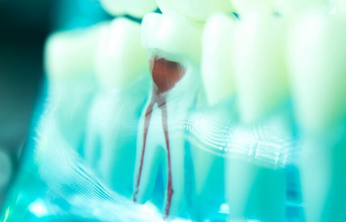Root Canal Myths