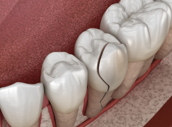 Illustration of a cracked tooth