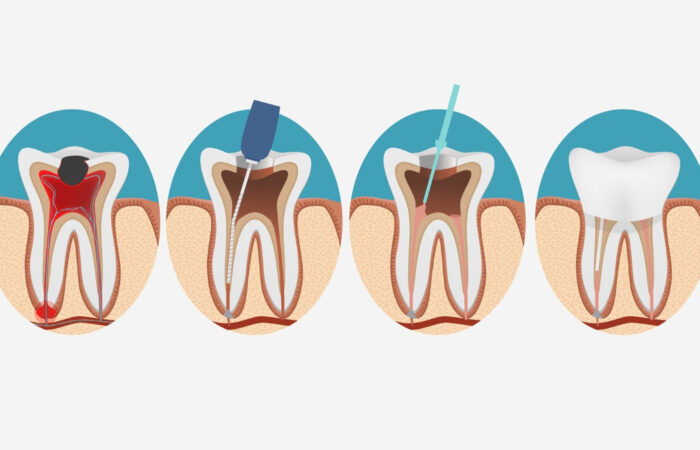 Root canal