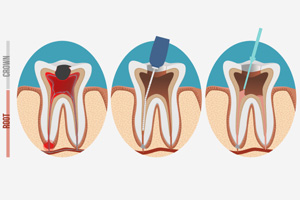 What Is Root Canal Retreatment? - Liv Endodontics