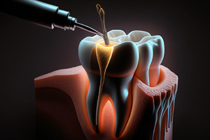 Root Canal