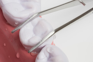 tooth extraction