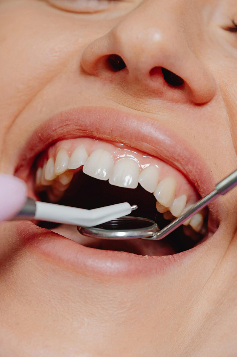 Cracked Tooth Treatment in Livingston and Summit, NJ