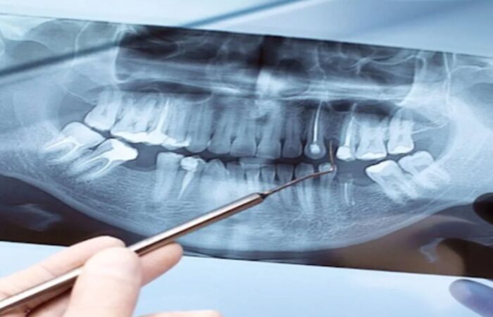 Apicoectomy Surgery