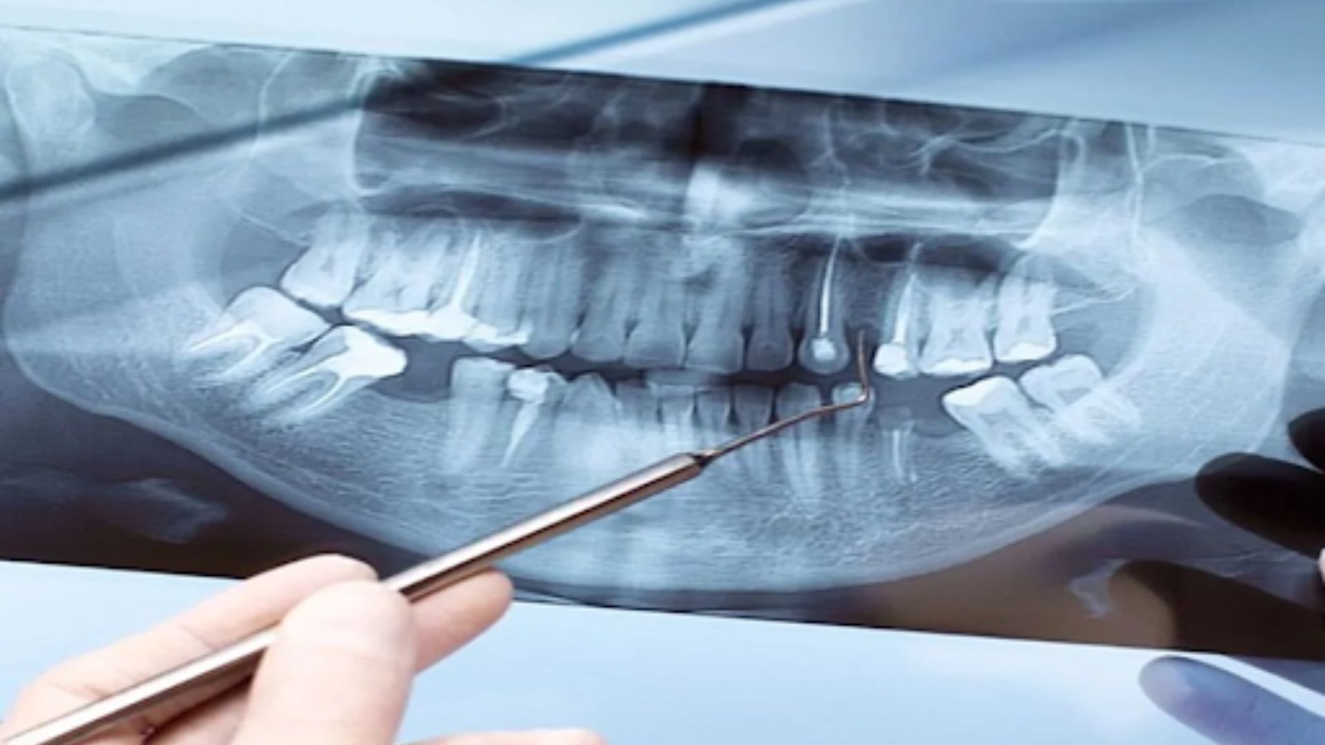 Apicoectomy Surgery
