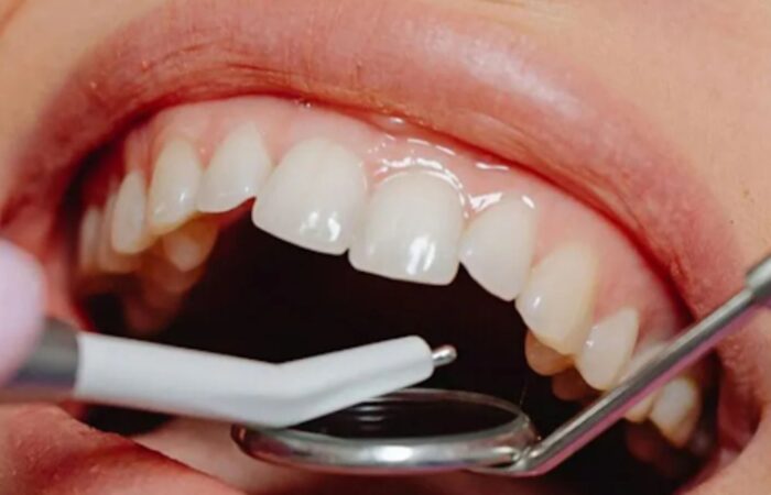Dental Apicoectomy Procedure
