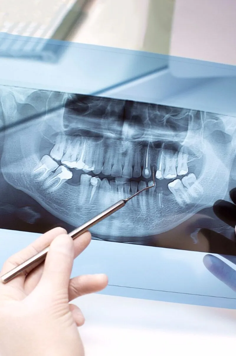 Root Apicoectomy Root Canal Apicoectomy: Precise Treatment for Tooth Infections