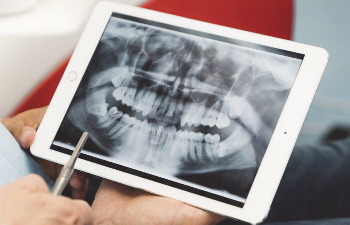 Understanding the Root Canal Retreatment Approach